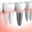 Pravilna oralna higijena zubnih implantata