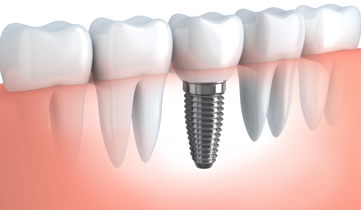 Zubni implant.