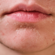 Zašto je ureja važna za suhu kožu sklonu ljuskanju?