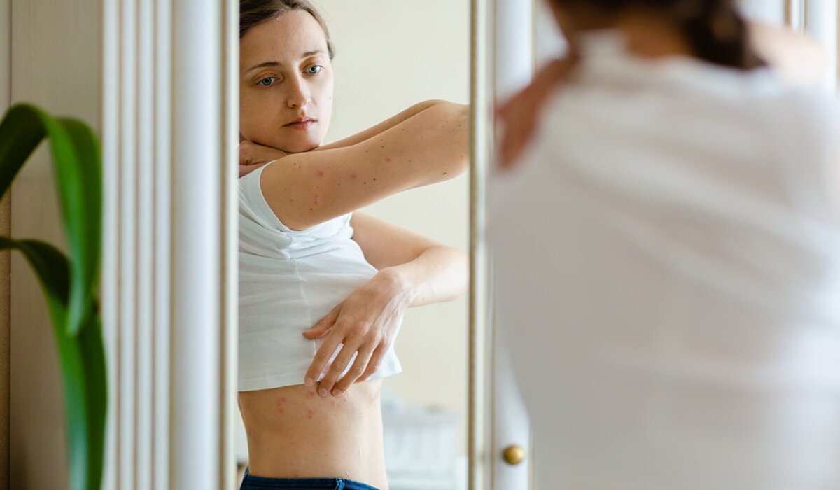 Žena s psorijazom po tijelu